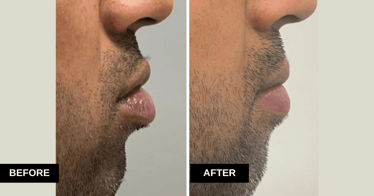 Lip Reduction result