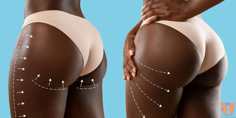 Brazilian Butt Lift in India