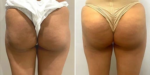 Brazilian Butt Lift Before and After