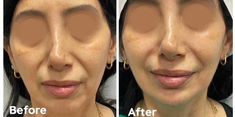 Chin and Jaw line fillers result