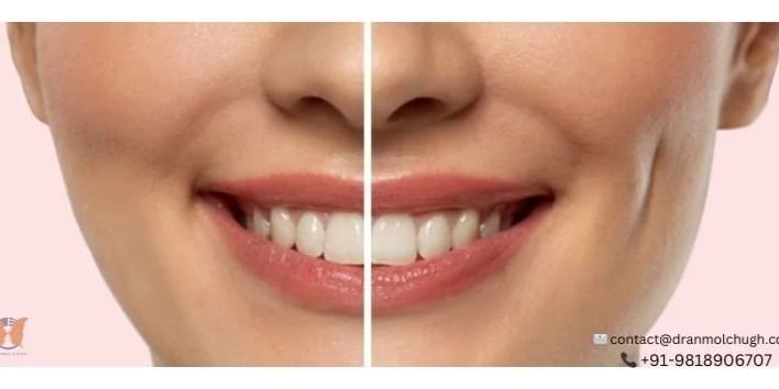 Dimple Creation Surgery How to Get the Smile of Your Dreams