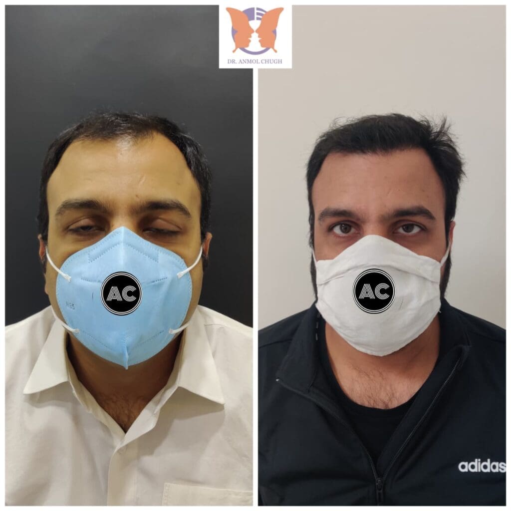 Hair Transplant Patient Result 2