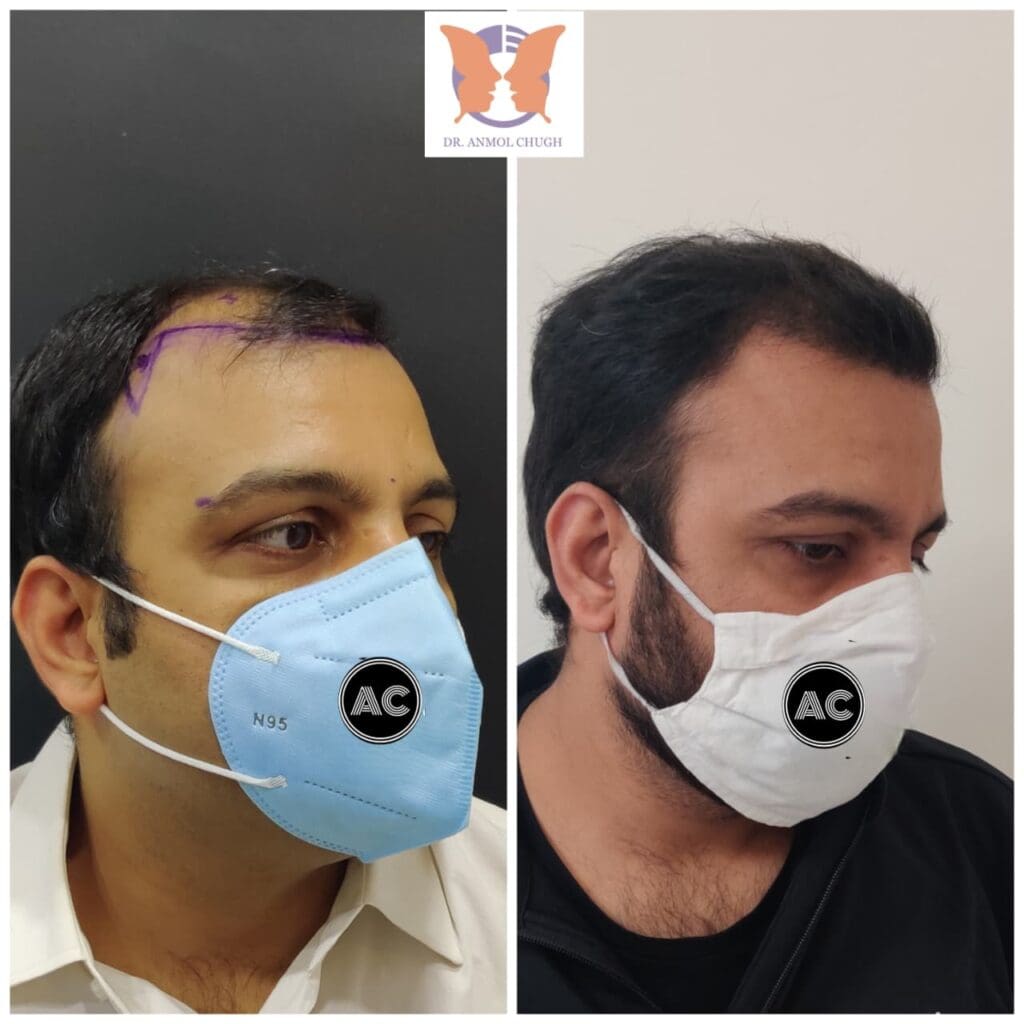 Hair Transplant Patient Result 3