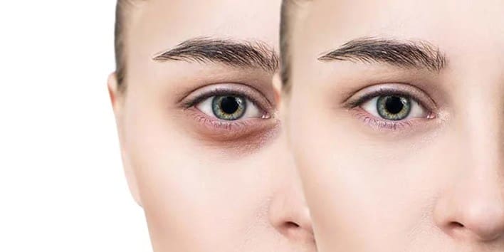 How-to-Remove-Dark-Circles