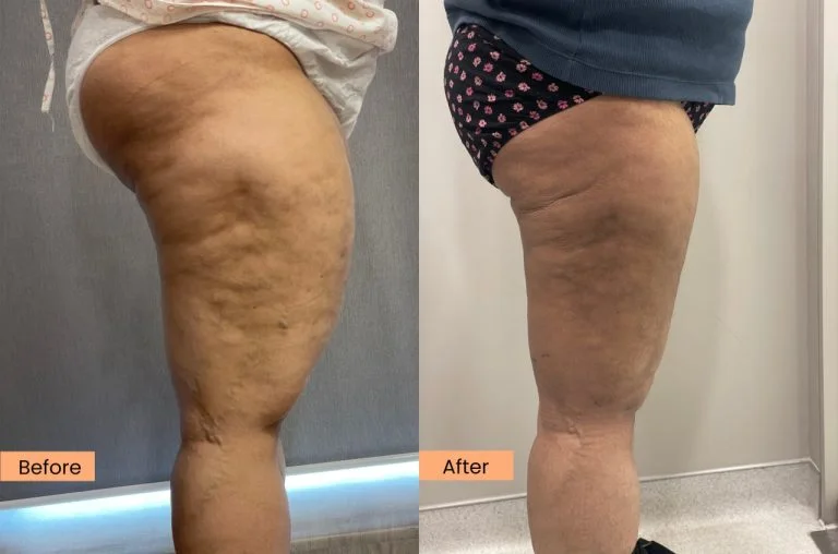 Lipedema 6 weeks post op 40-year-old female