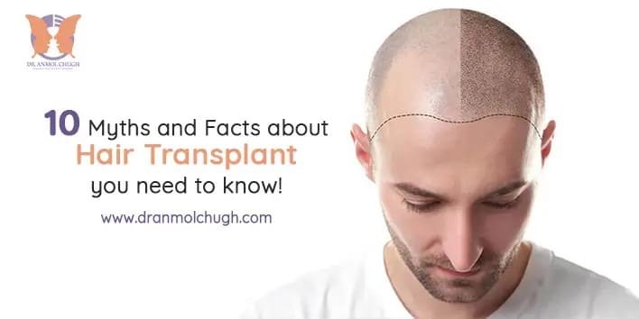 Myths-and-Facts-about-Hair-Transplant