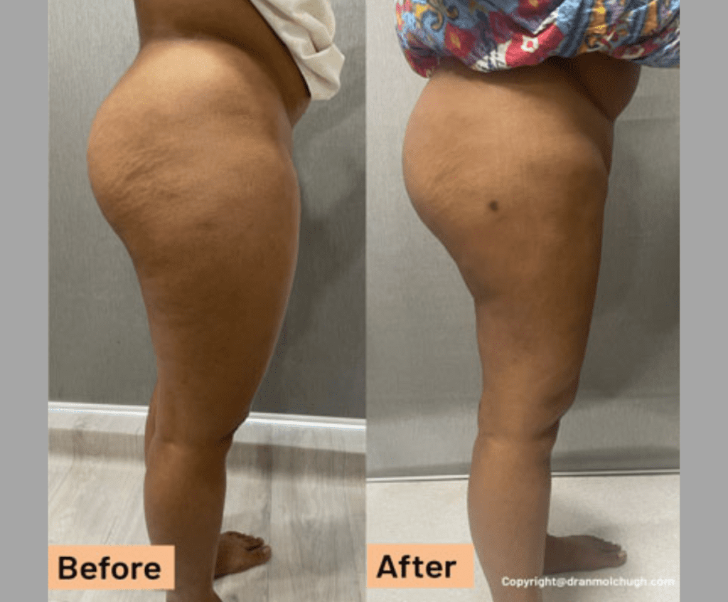 Thigh liposuction, 2 months postop, 32 year old female