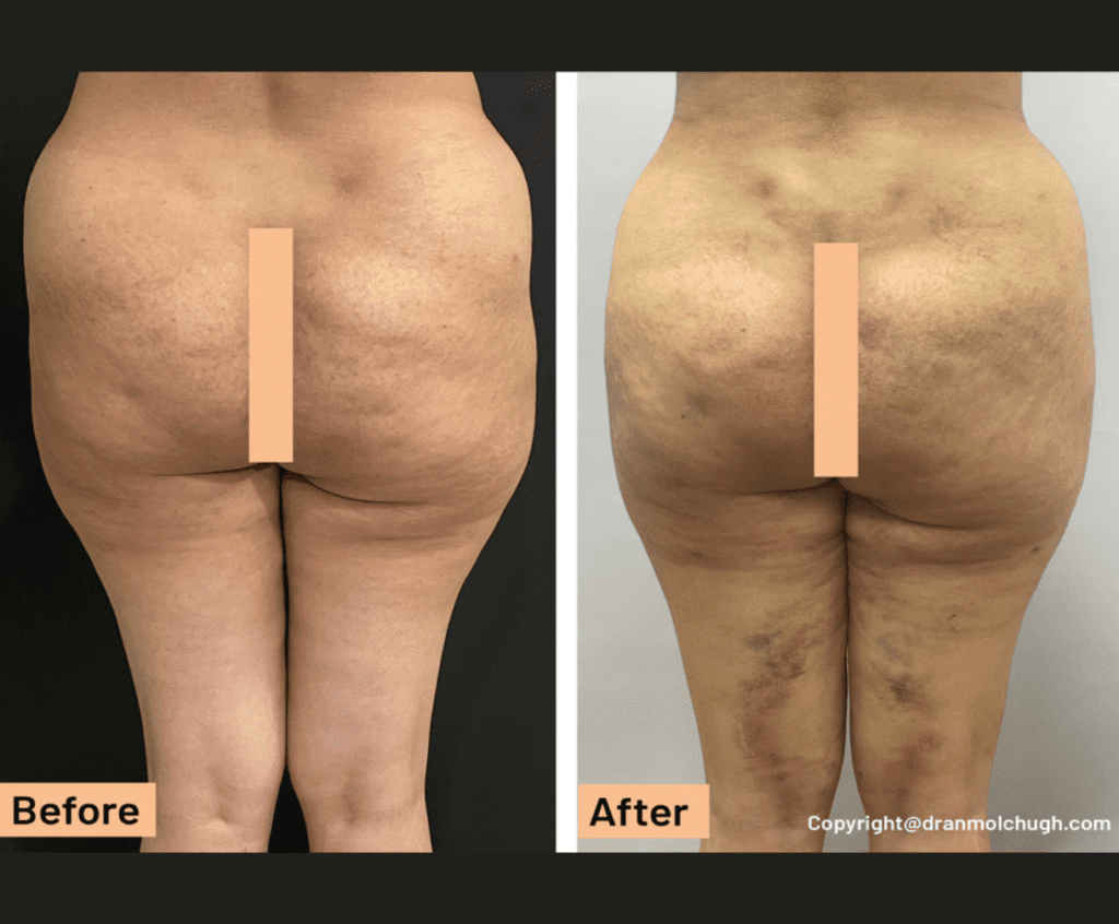 Female Thigh liposuction Surgery – 1 week postop