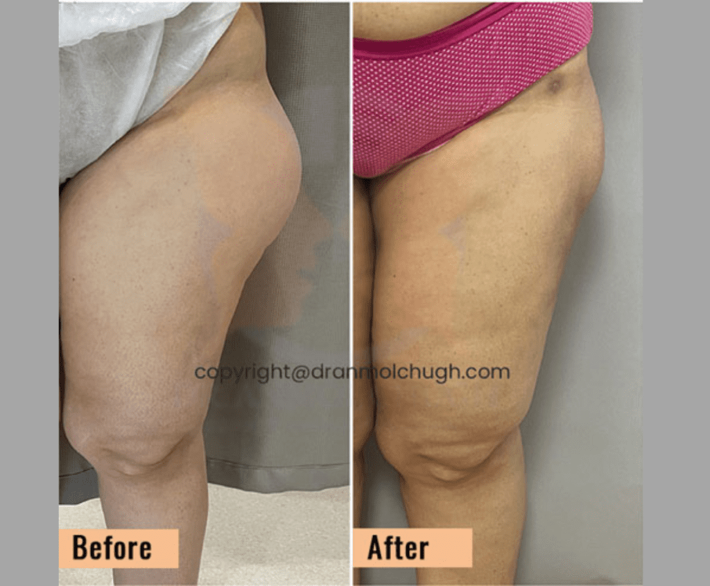 Thigh liposuction with saddle bag deformity correction