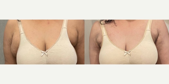 Transformative results of axillary breast reduction for a 44 year old woman