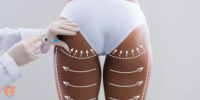 Understanding the side effects of Brazilian Butt Lift surgery