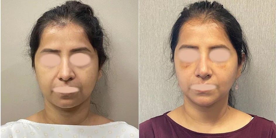 buccal fat surgery result