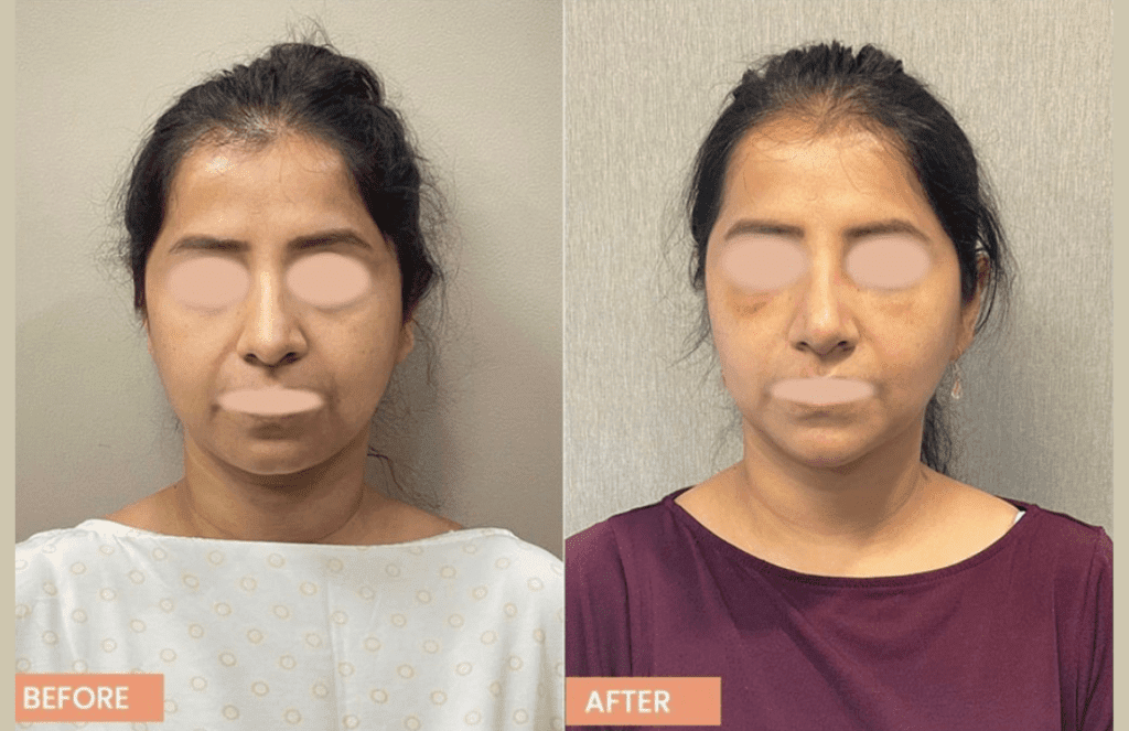 Facial Fat Grafting