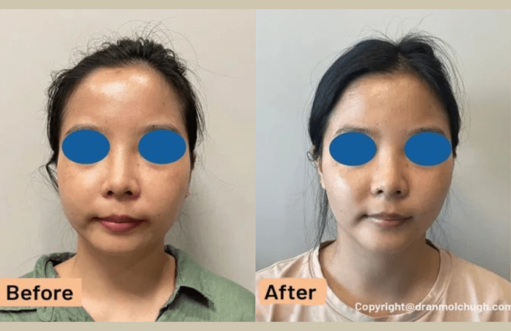 Buccal Fat Pad Removal with Chin Implant
