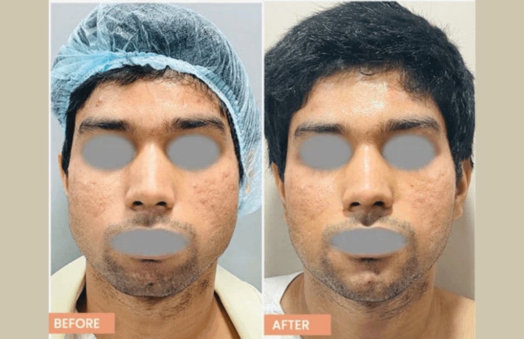 buccal fat removal result