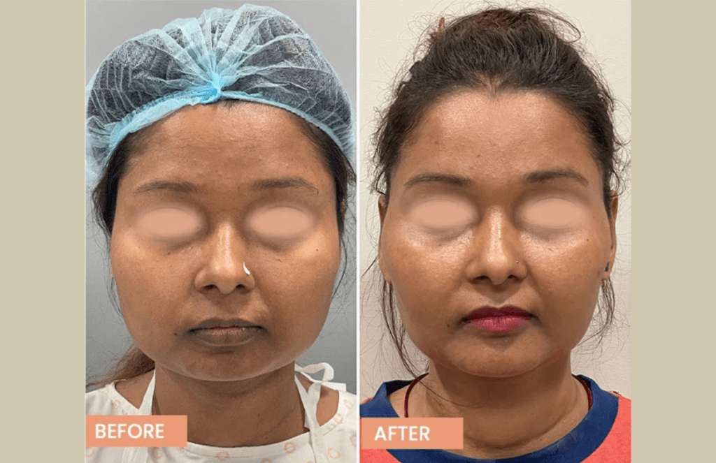 buccal fat removal result