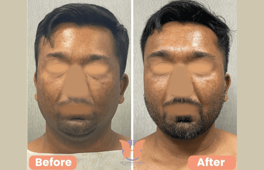Buccal Fat Pad Removal