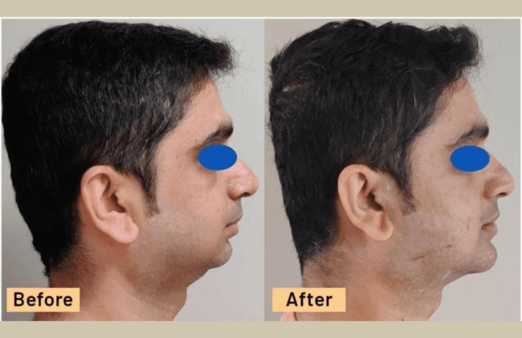 buccal fat removal result