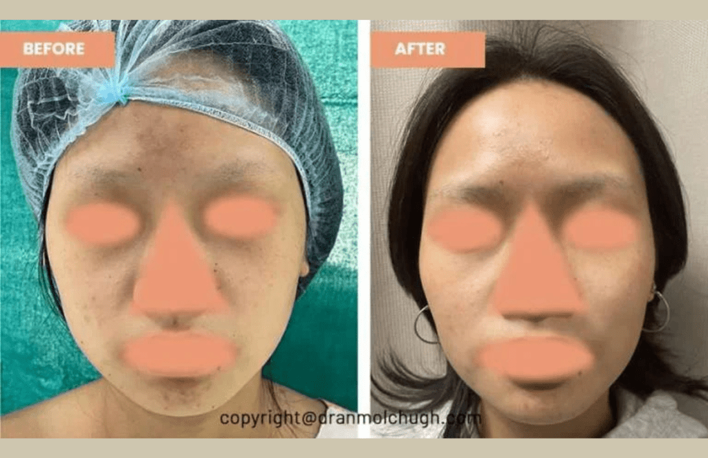 buccal fat removal result