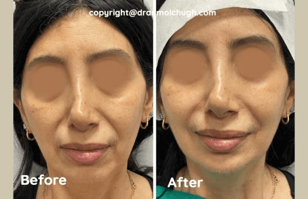 Chin result
