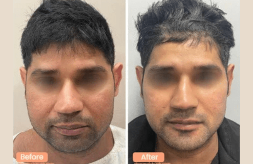 Chin result