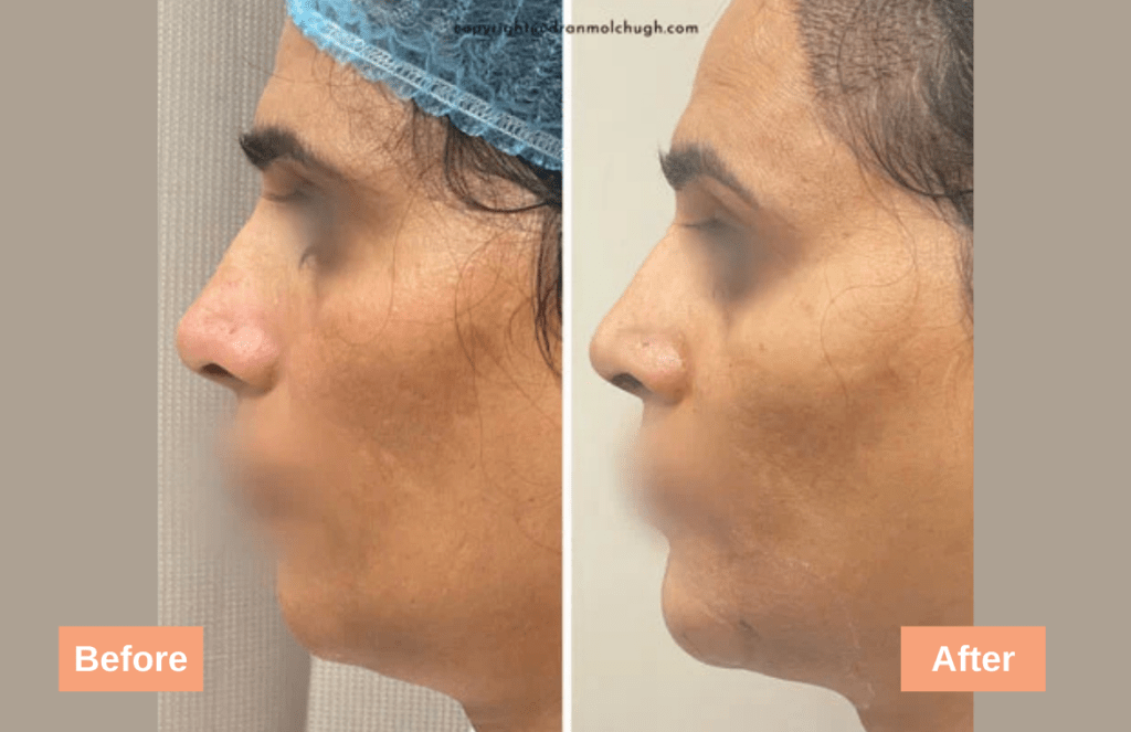 Chin fillers result