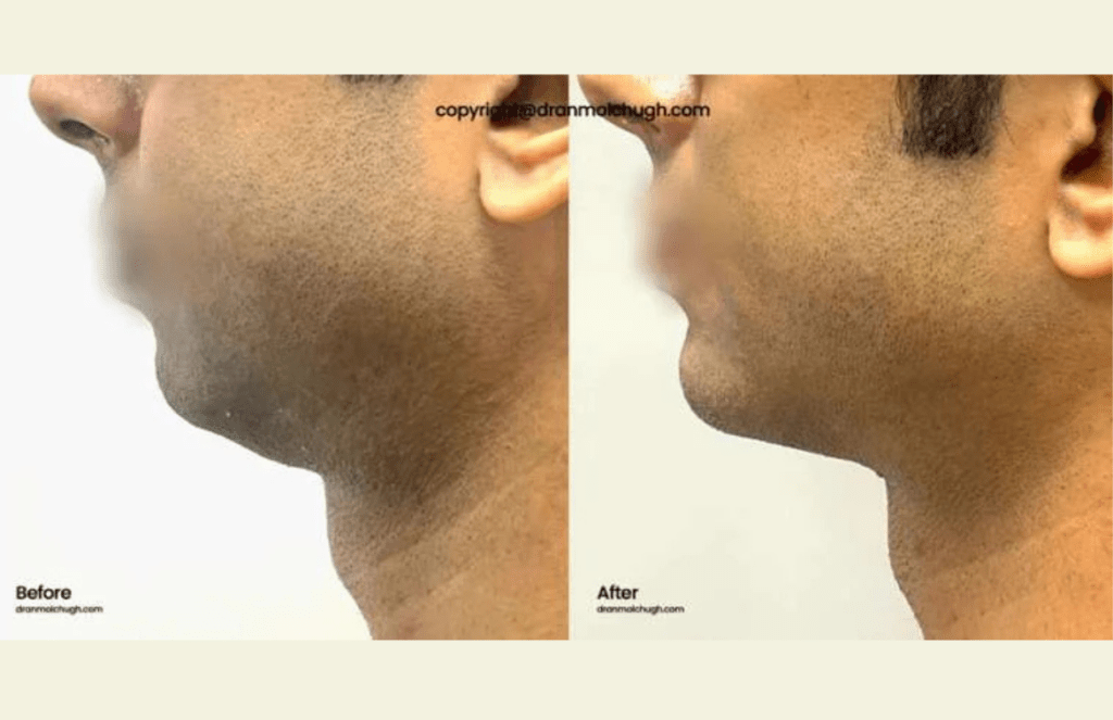 Chin fillers result