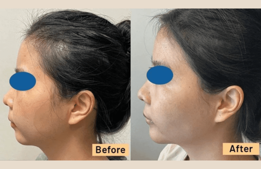Chin result