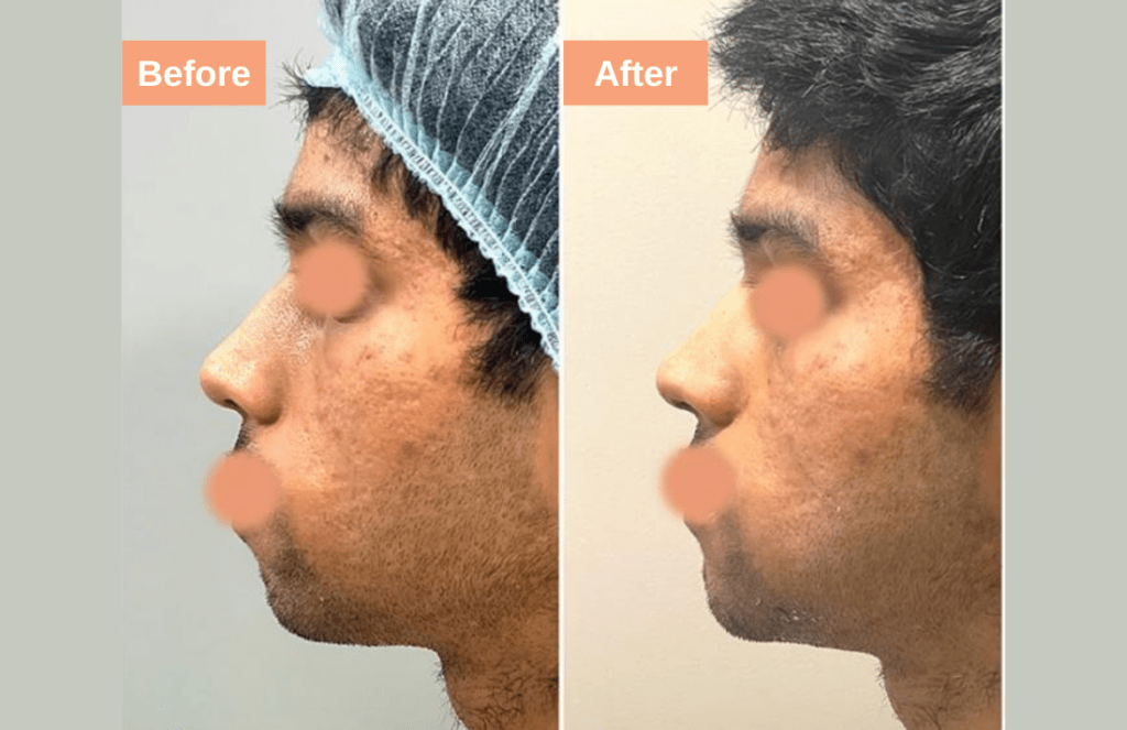 Chin result