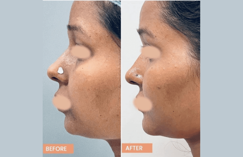 Chin result
