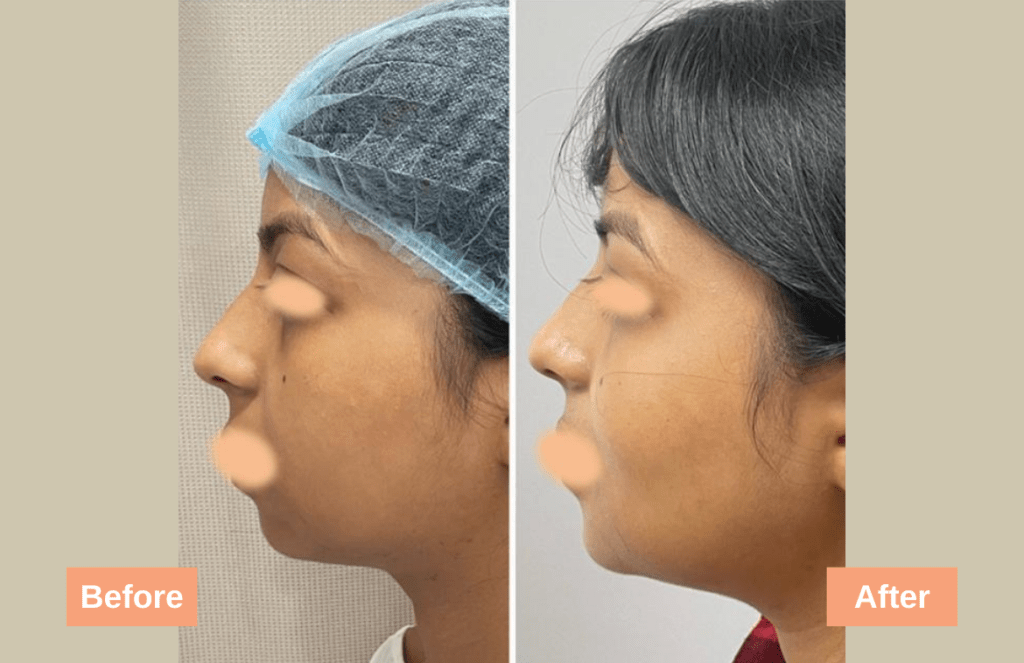 Chin result
