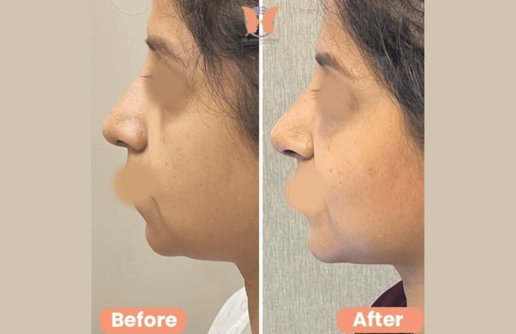 Chin result