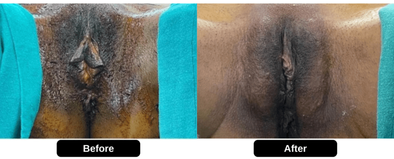 Female Genital Rejuvenation Before and After