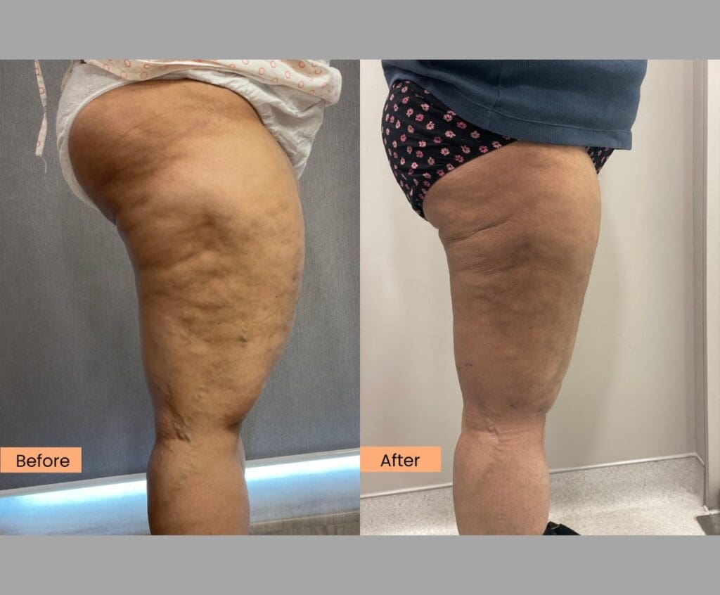 Thigh Liposuction Surgery 2 months post-op 40 year old female