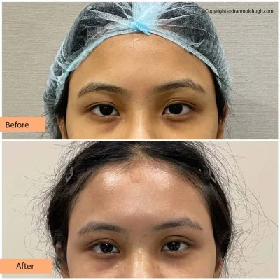 Asian Blepharoplasty, 21/F, 10 days Post Op