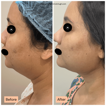 45-54 year old woman treated with Chin Liposuction