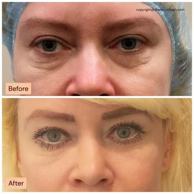 54 year old, 3 months post lower lid blepharoplasty + fat transfer – smoother under-eyes and refreshed look.