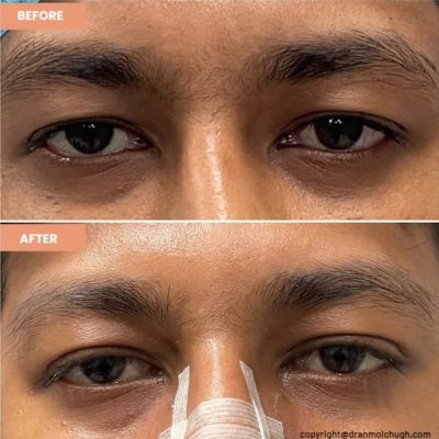 Customised Upper Blepharoplasty