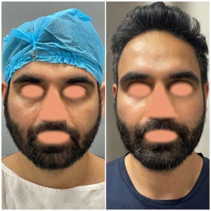 25-34 year old man treated with Chin Liposuction, Buccal Fat Removal